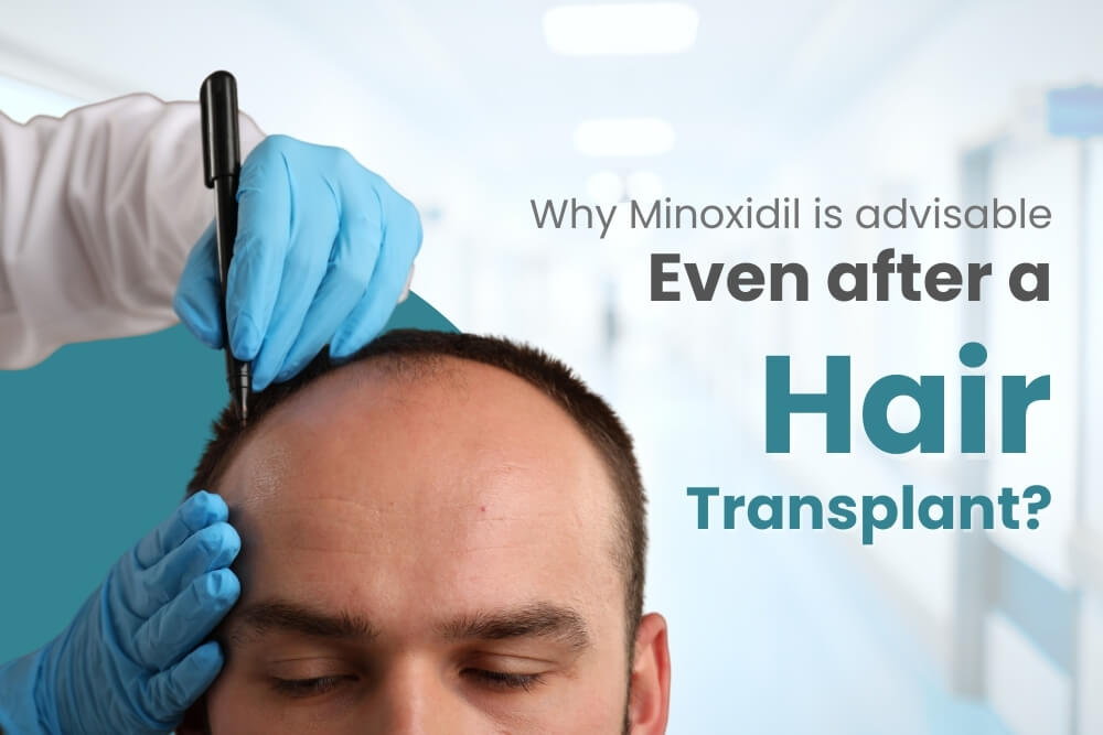 why-minoxidil
