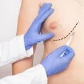 Gynecomastia