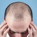 Hair Transplant