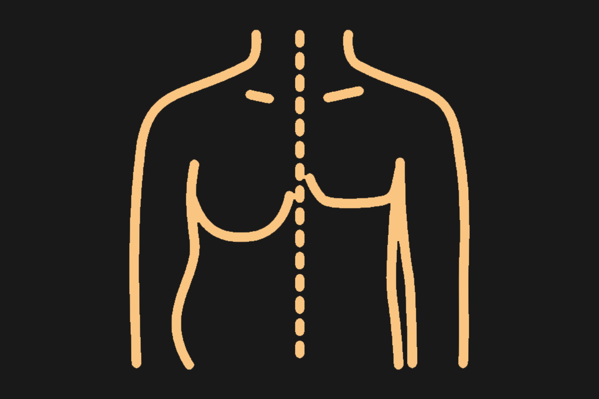 Asymmetric Gynecomastia